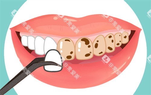 牙齿贴面动画图