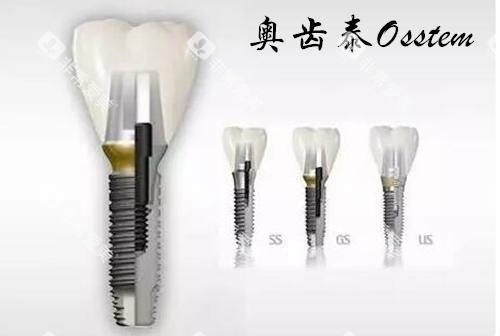 奥齿泰种植牙US系列 奥齿泰种植牙US系列