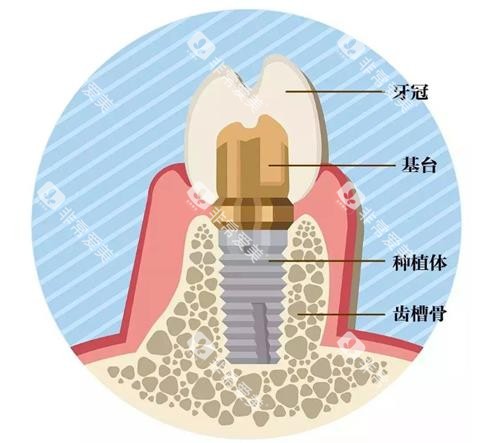 种植牙的组成