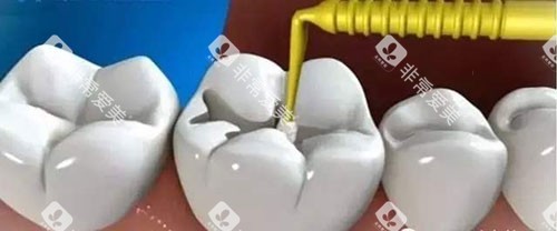 补牙治疗过程示意图