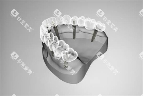 半口种植牙模拟示意图 半口种植牙模拟示意图