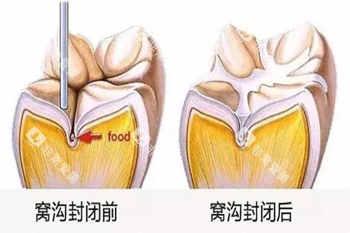 牙齿窝沟封闭前后对比卡通示意图