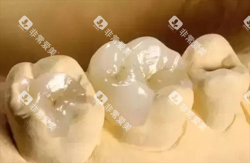 补牙模型展示图