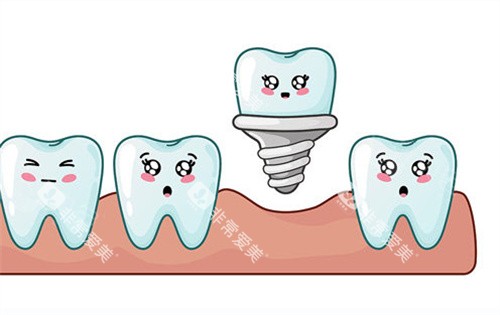 种植牙动画展示图片 种植牙动画展示图片