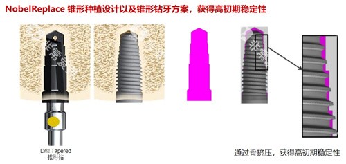 诺贝尔种植牙 (2) 诺贝尔种植牙 (2)