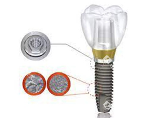 植是道种植牙 植是道种植牙