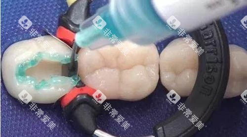 儿童补牙材料