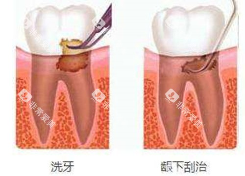 洗牙和龈下刮治对比示意图