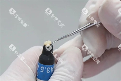 医生取补牙树脂