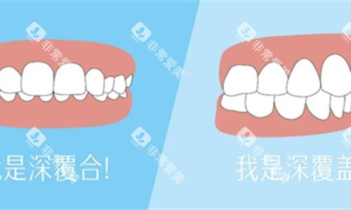 牙齿深覆合展示对比 牙齿深覆合展示对比
