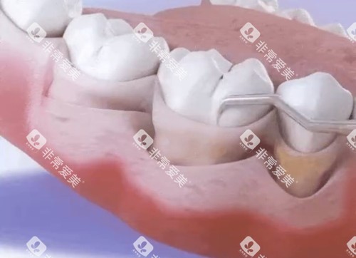 牙周刮治卡通示意图