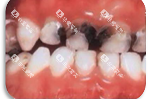 牙根龋坏图片 