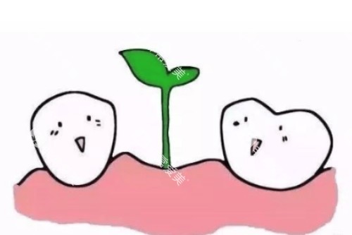 种植牙概念图