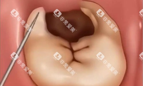 牙齿龋齿卡通图