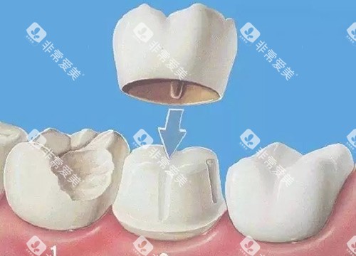 牙冠动画展示图