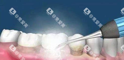 洗牙卡通示意图