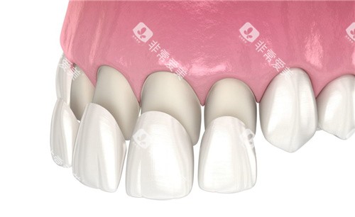 前牙四颗牙齿贴面