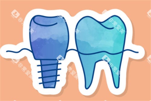 种植牙和正常牙齿