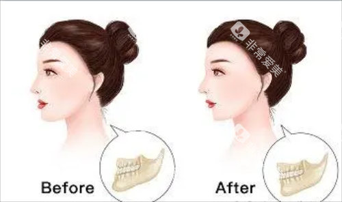 正颌手术后的成效图片