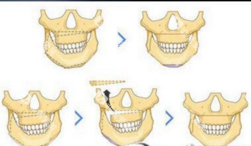 正颌流程示意图