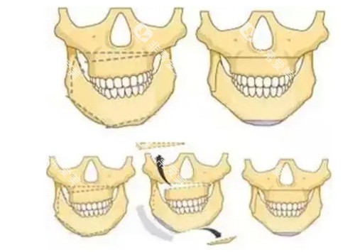正颌手术卡通照片