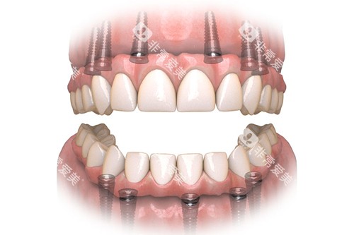all-on-6全口种植牙示意图