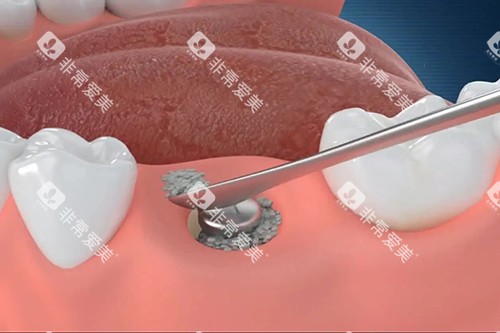 <span class='highlight'>微创</span>种植牙基台安装示意图