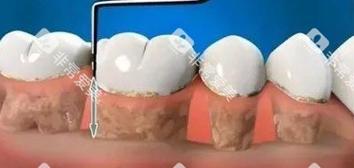 种植牙手术图片