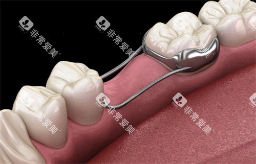 牙齿间隙保持器