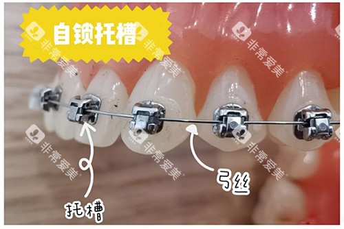 牙齿矫正自锁托槽牙套