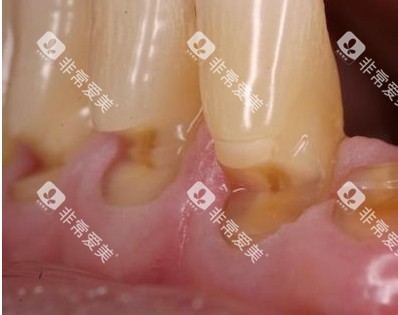 牙龈萎缩照片