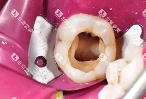 牙齿根管治疗图片
