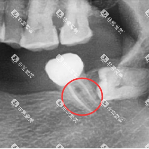 根管治疗后的牙齿
