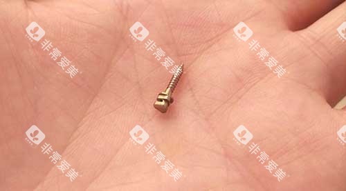 牙齿矫正骨钉种植钉3