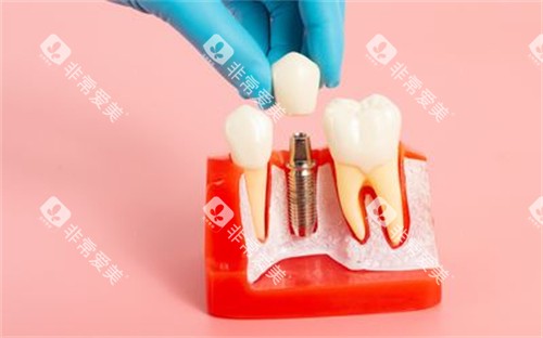 种植牙模型展示图 种植牙模型展示图