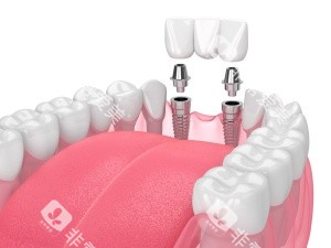 牙齿种植结构示意图 牙齿种植结构示意图