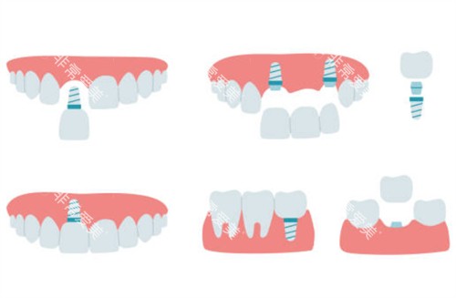 牙齿缺失种植牙示意图 牙齿缺失种植牙示意图