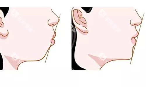 深覆合牙齿矫正前后整体对比图 深覆合牙齿矫正前后整体对比图