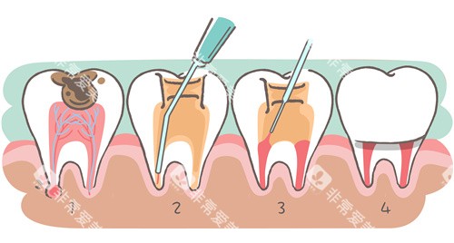 牙齿根管治疗步骤 牙齿根管治疗步骤