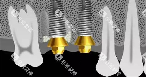 种植牙术后ct 种植牙术后ct