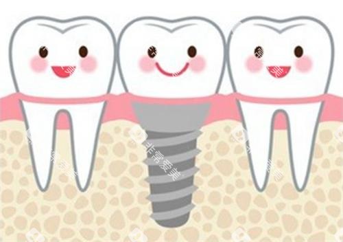 种植牙后动画展示图 种植牙后动画展示图