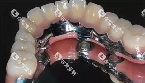 半口种植牙齿照片 半口种植牙齿照片