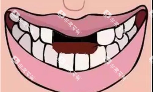 门牙缺失卡通图 门牙缺失卡通图