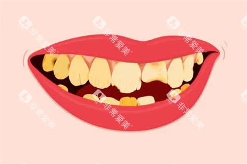 门牙缺失 门牙缺失