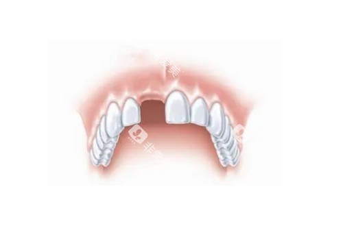 门牙缺失图片展示 门牙缺失图片展示