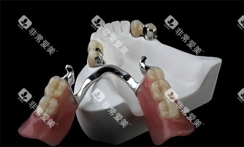 精密附着体义齿是什么