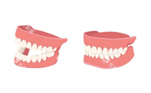 假牙示意图 假牙示意图