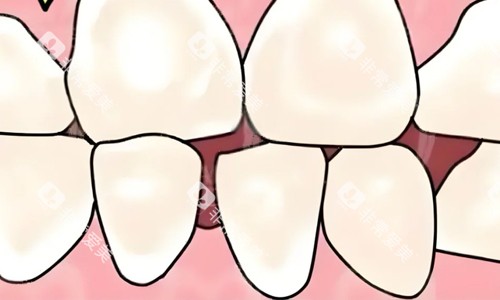 儿牙牙缝宽大