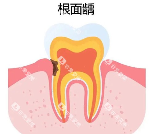 根面龋示意图片.webp