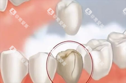 重度龋齿需要做嵌体的情况